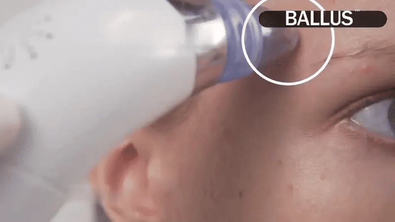 UltraGlow Pore Vacuum–وتنظيف المسام بعمق